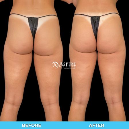Before and After Images of Aspire MedSpa & Beauty Bar in Tampa, FL