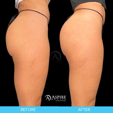 Before and After Images of Aspire MedSpa & Beauty Bar in Tampa, FL