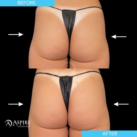 Before and After Images of Aspire MedSpa & Beauty Bar in Tampa, FL