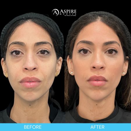 Before and After Images of Aspire MedSpa & Beauty Bar in Tampa, FL