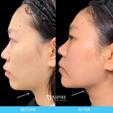 Before and After Images of Aspire MedSpa & Beauty Bar in Tampa, FL