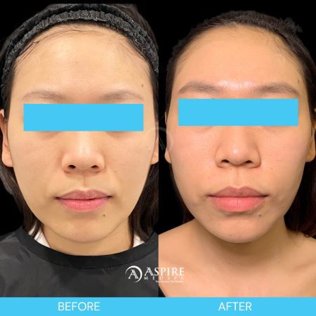 Before and After Images of Aspire MedSpa & Beauty Bar in Tampa, FL