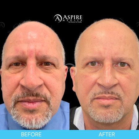 Before and After Images of Aspire MedSpa & Beauty Bar in Tampa, FL