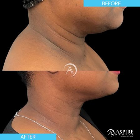 Before and After Images of Aspire MedSpa & Beauty Bar in Tampa, FL