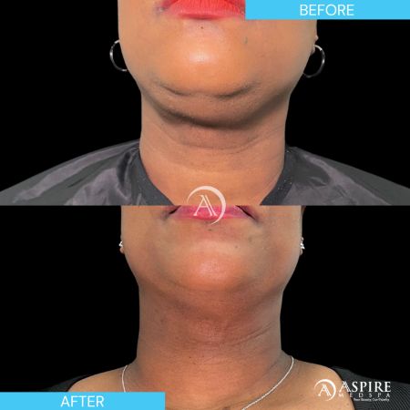 Before and After Images of Aspire MedSpa & Beauty Bar in Tampa, FL