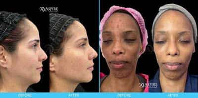 Our Results at Aspire MedSpa and Beauty Bar