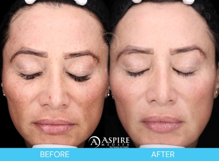 Enlighten Peel Before and After Images in Tampa, FL