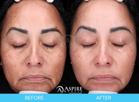 Enlighten Peel Before and After Images in Tampa, FL