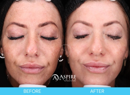 Enlighten Peel Before and After Images in Tampa, FL