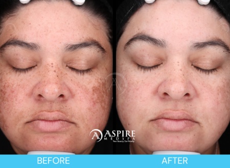 Enlighten Peel Before and After Images in Tampa, FL
