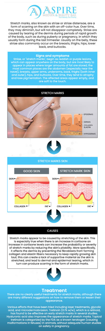 Common questions asked by clients: What causes stretch marks and how can they be prevented? Are there any effective treatments to reduce the appearance of stretch marks? Can stretch marks be completely removed with treatments? How long does it take to see results from treatments for stretch marks? For more information, contact us or schedule an appointment online. We are conveniently located at 12932 N Dale Mabry Hwy, Tampa, FL 33618. We serve clients from Tampa FL, Egypt Lake-Leto FL, Town ‘n’ Country FL, Westchase FL, Temple Terrace FL, Lutz FL, Oldsmar FL, Keystone FL, Wesley Chapel FL, and surrounding areas.
