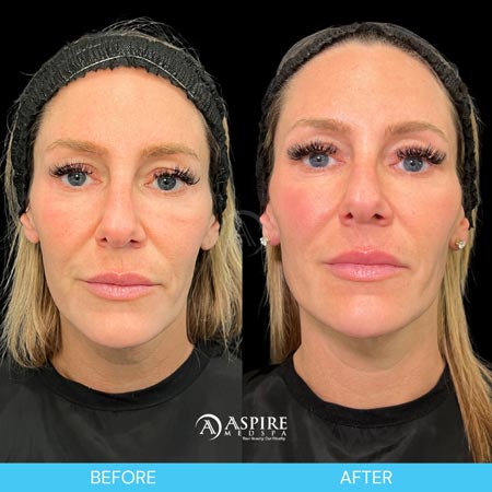 Before and After Images of Aspire MedSpa & Beauty Bar in Tampa, FL