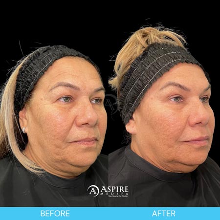 Before and After Images of Aspire MedSpa & Beauty Bar in Tampa, FL