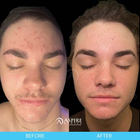 Before and After Images of Aspire MedSpa & Beauty Bar in Tampa, FL