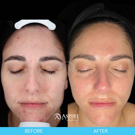 Before and After Images of Aspire MedSpa & Beauty Bar in Tampa, FL