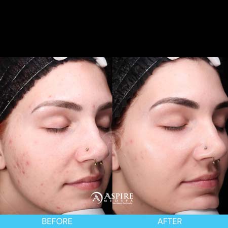 Before and After Images of Aspire MedSpa & Beauty Bar in Tampa, FL