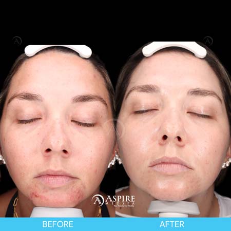 Before and After Images of Aspire MedSpa & Beauty Bar in Tampa, FL