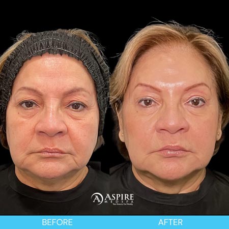 Before and After Images of Aspire MedSpa & Beauty Bar in Tampa, FL