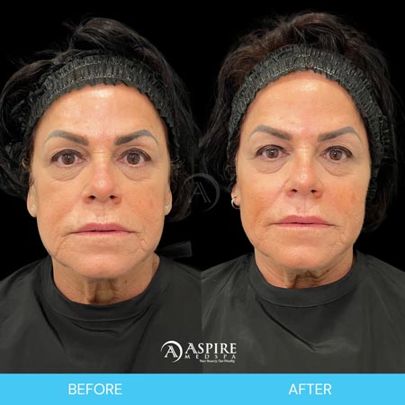 Before and After Images of Aspire MedSpa & Beauty Bar in Tampa, FL