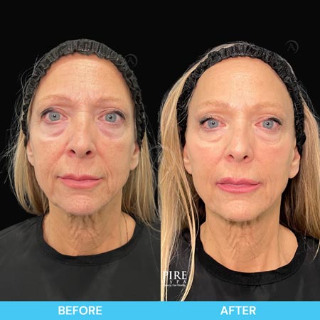 Before and After Images of Aspire MedSpa & Beauty Bar in Tampa, FL