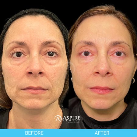 Before and After Images of Aspire MedSpa & Beauty Bar in Tampa, FL
