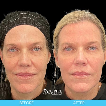 Before and After Images of Aspire MedSpa & Beauty Bar in Tampa, FL
