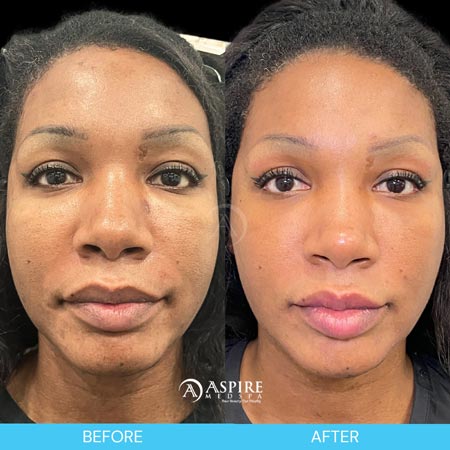 Before and After Images of Aspire MedSpa & Beauty Bar in Tampa, FL