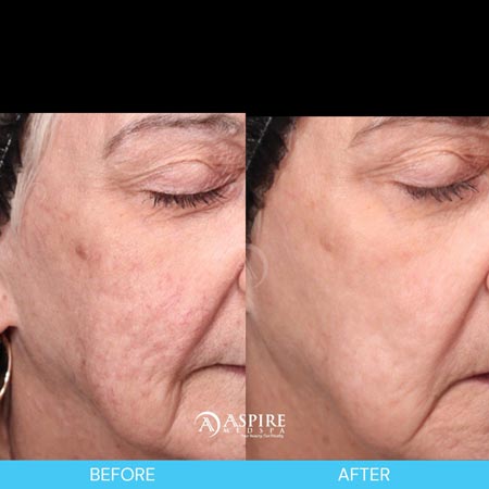 Before and After Images of Aspire MedSpa & Beauty Bar in Tampa, FL