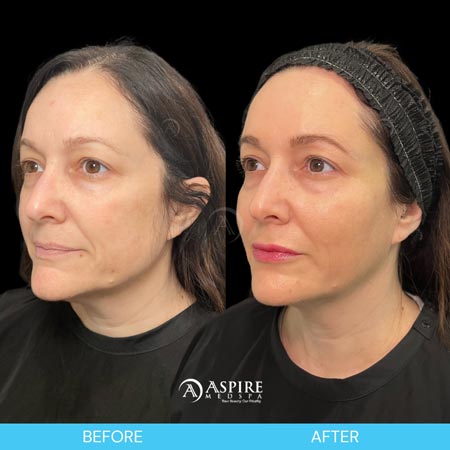 Before and After Images of Aspire MedSpa & Beauty Bar in Tampa, FL