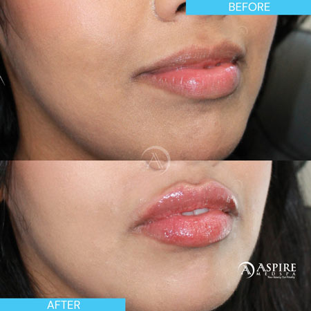 Before and After Images of Aspire MedSpa & Beauty Bar in Tampa, FL