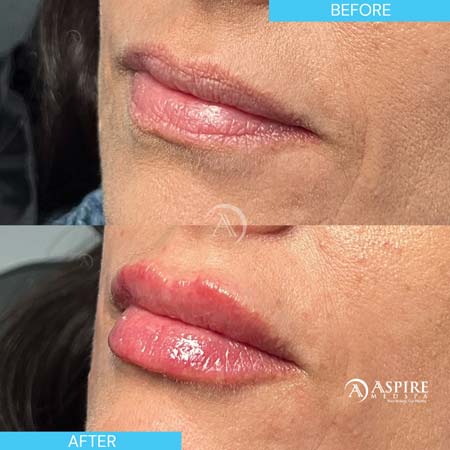 Before and After Images of Aspire MedSpa & Beauty Bar in Tampa, FL