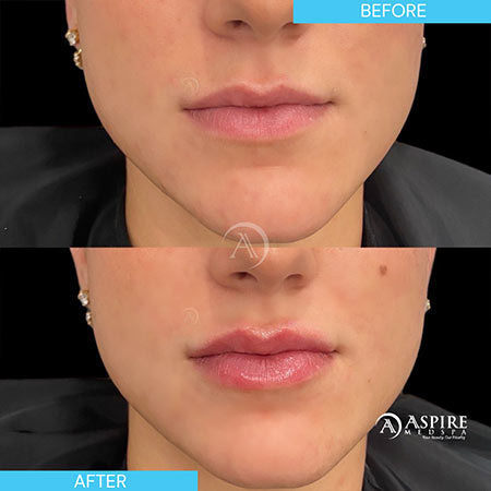 Before and After Images of Aspire MedSpa & Beauty Bar in Tampa, FL Before and After Images of Aspire MedSpa & Beauty Bar in Tampa, FL