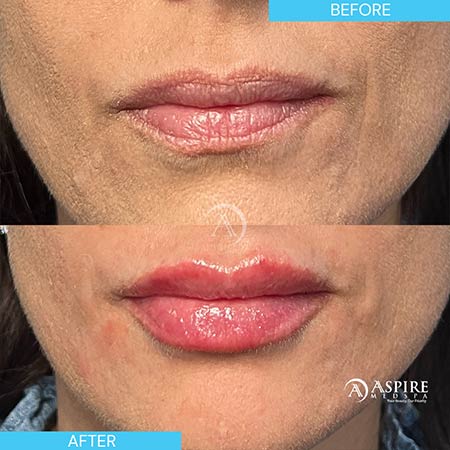 Before and After Images of Aspire MedSpa & Beauty Bar in Tampa, FL Before and After Images of Aspire MedSpa & Beauty Bar in Tampa, FL