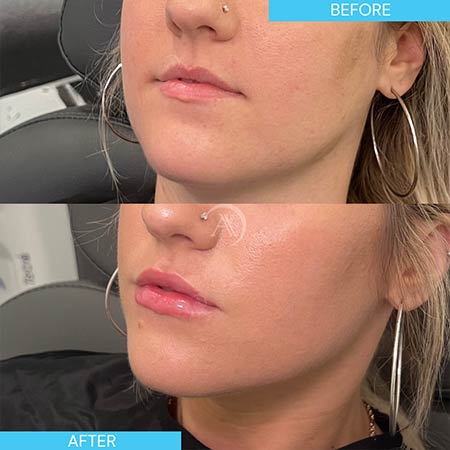 Before and After Images of Aspire MedSpa & Beauty Bar in Tampa, FL Before and After Images of Aspire MedSpa & Beauty Bar in Tampa, FL