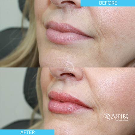 Before and After Images of Aspire MedSpa & Beauty Bar in Tampa, FL Before and After Images of Aspire MedSpa & Beauty Bar in Tampa, FL