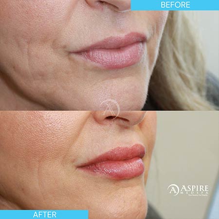 Before and After Images of Aspire MedSpa & Beauty Bar in Tampa, FL Before and After Images of Aspire MedSpa & Beauty Bar in Tampa, FL