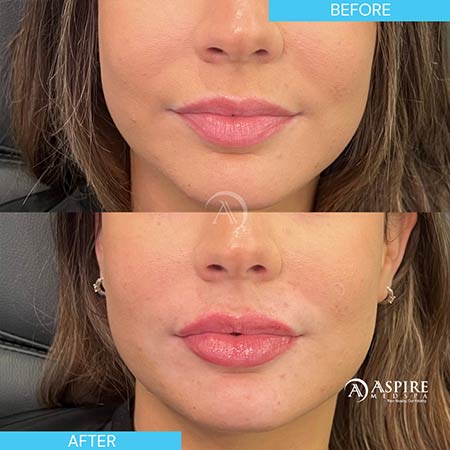 Before and After Images of Aspire MedSpa & Beauty Bar in Tampa, FL Before and After Images of Aspire MedSpa & Beauty Bar in Tampa, FL