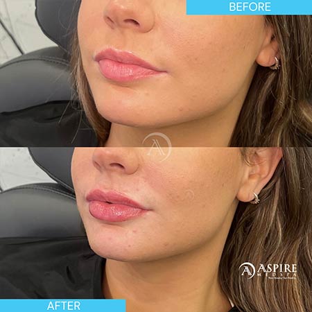 Before and After Images of Aspire MedSpa & Beauty Bar in Tampa, FL Before and After Images of Aspire MedSpa & Beauty Bar in Tampa, FL