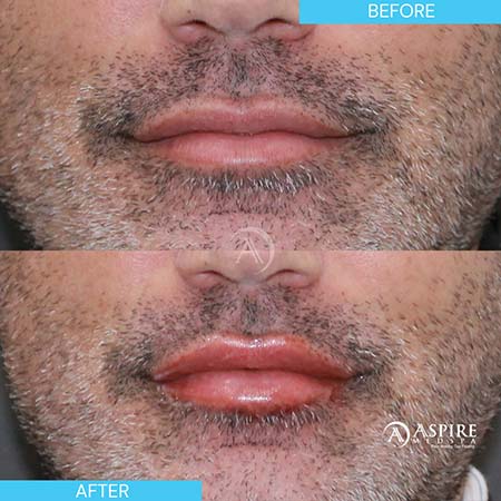 Before and After Images of Aspire MedSpa & Beauty Bar in Tampa, FL Before and After Images of Aspire MedSpa & Beauty Bar in Tampa, FL