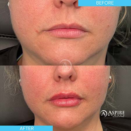 Before and After Images of Aspire MedSpa & Beauty Bar in Tampa, FL Before and After Images of Aspire MedSpa & Beauty Bar in Tampa, FL