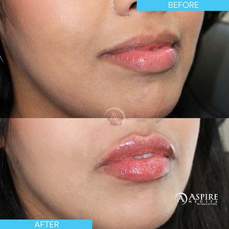 Before and After Images of Aspire MedSpa & Beauty Bar in Tampa, FL Before and After Images of Aspire MedSpa & Beauty Bar in Tampa, FL