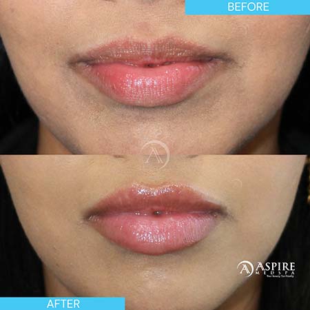 Before and After Images of Aspire MedSpa & Beauty Bar in Tampa, FL Before and After Images of Aspire MedSpa & Beauty Bar in Tampa, FL