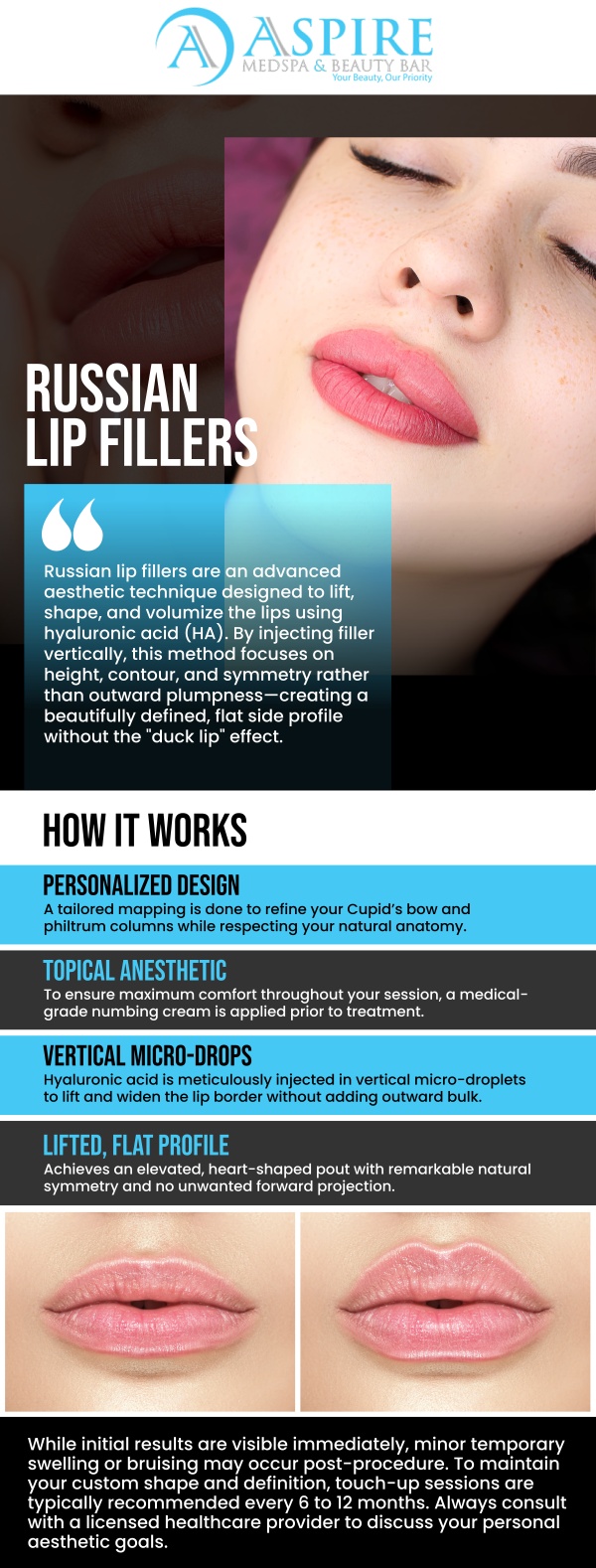 Discover unmatched facial balance through the innovative Russian lip filler method, masterfully administered by Rosaly Stephens, MSN, ARNP-C, at Aspire MedSpa and Beauty Bar. Utilizing a strategic approach that deposits micro-droplets of hyaluronic acid in precise vertical columns, Rosaly carefully refines irregular borders, corrects imbalances, and elegantly accentuates the Cupid’s bow. The outcome is a flawlessly contoured, heart-shaped smile that perfectly complements your distinct facial architecture, all while preserving a sleek, flat side profile without any unnatural forward bulging. For more information, contact us or schedule an appointment online. We are conveniently located at 12932 N Dale Mabry Hwy, Tampa, FL 33618.